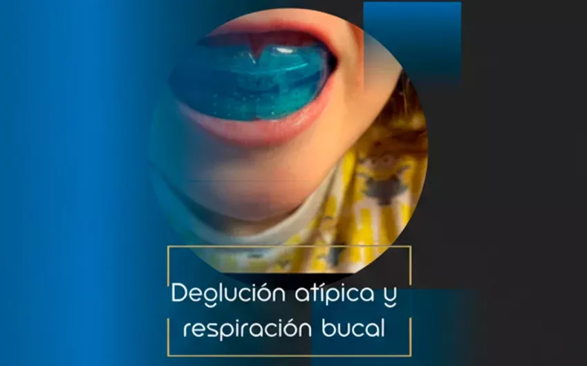 Tratamiento de deglución atípica y respiración bucal en niños en la Clínica Dental Lacaci, con enfoque en la salud dental y respiratoria.