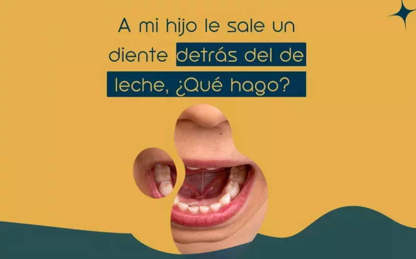 Dientes de tiburón en niños, una condición dental que puede corregirse con el tratamiento adecuado en la Clínica Dental Lacaci.