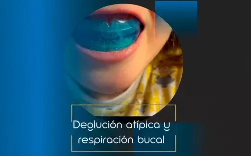 Tratamiento de deglución atípica y respiración bucal en niños en la Clínica Dental Lacaci, con enfoque en la salud dental y respiratoria.