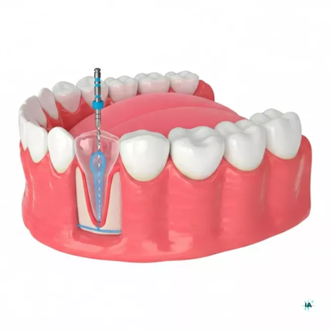 Endodoncia en Alcobendas para eliminar infección y conservar el diente